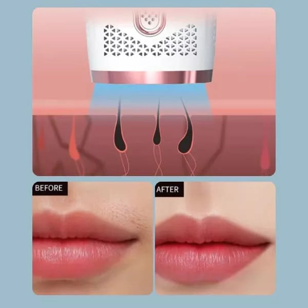 IPL Laser-Epilierer Körperhaarentfernung