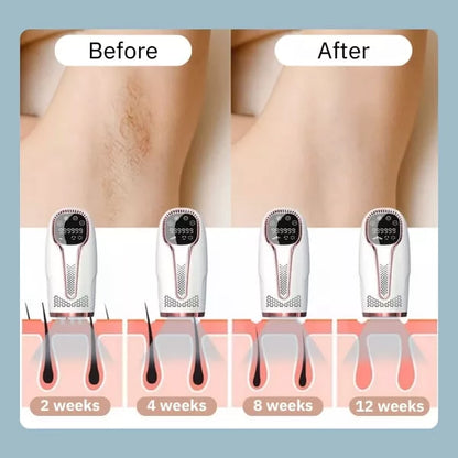 IPL Laser-Epilierer Körperhaarentfernung